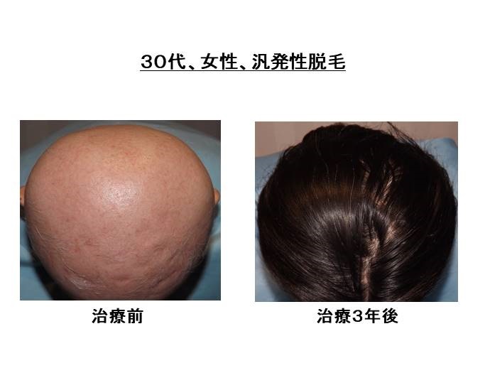 円形脱毛症　病院""